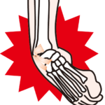 捻挫を早期改善に導く