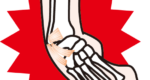 捻挫を早期改善に導く