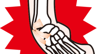 捻挫を早期改善に導く